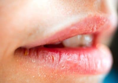 What can you do to your Chapped Lips?